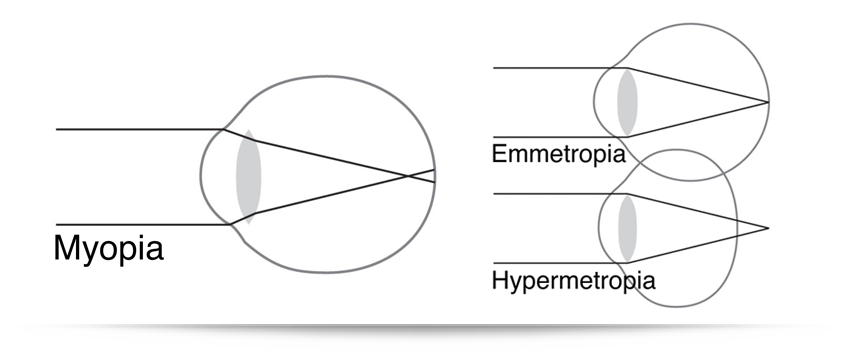 What Do We Do When We Find Astigmatism?