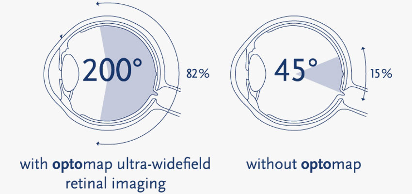 Optomap Retinal Imaging Comparison